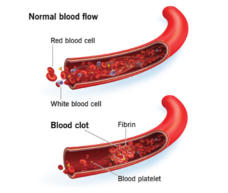 Bleeding Disorders (Thrombocytopenia, Hemophilia, Rare Factor Deficiency)