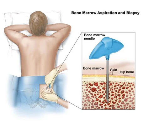 
                      
                      
                      Bone Marrow Biopsy
                  
                  
                  