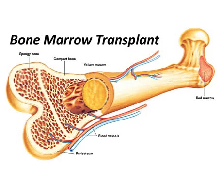 
                      
                      
                      Bone Marrow Transplant
                  
                  
                  