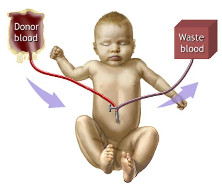 Exchange Transfusion