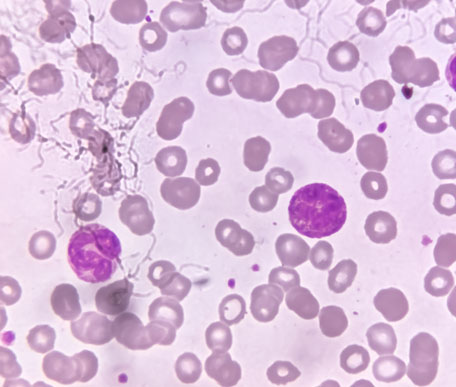Pancytopenia (Aplastic Anemia, Inherited Bone Marrow Failure Syndromes)