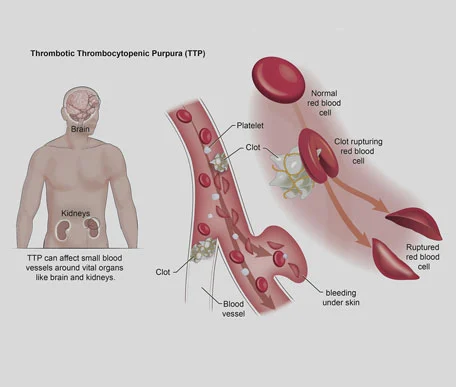 
                      Thrombotic Disorders (Thrombophilia, TTP, HUS)
                  