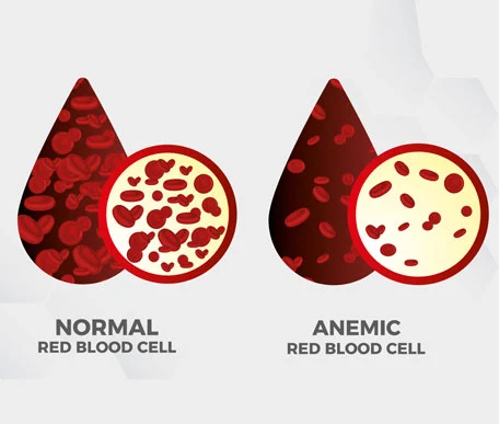 
                      Anemia
                  